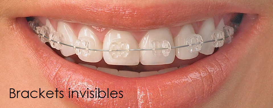 Brackets invisibles cuidar tu ortodoncia
