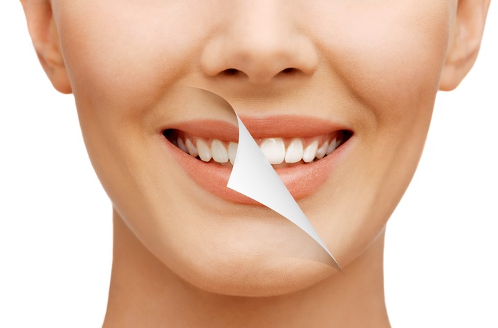 Blanqueamiento dental Clínica Dental